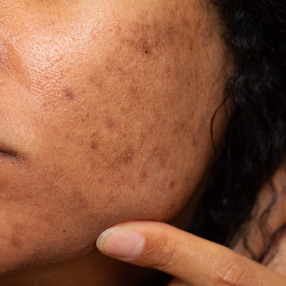 Dark Spots