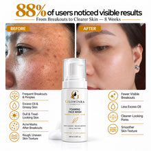 Acne Foaming Face Wash For Clearer Skin