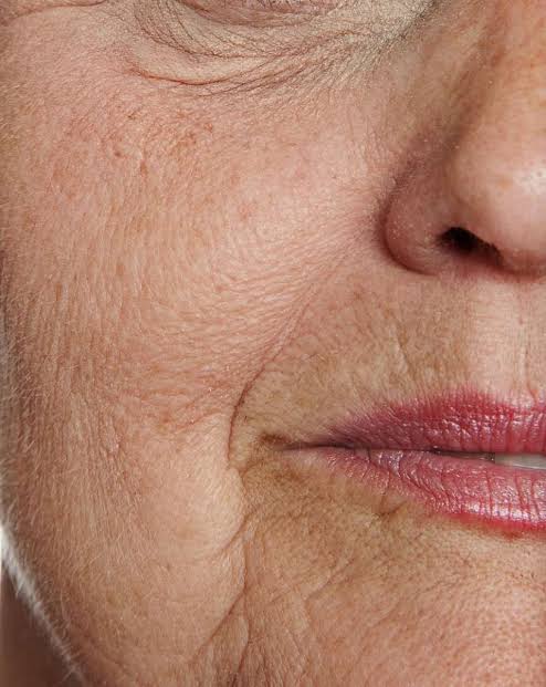 Ageing skin
